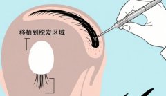 南京新生医疗美容门诊部怎么样？植发机构信息汇总，发友关注点都在这