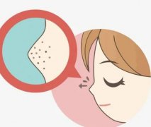 鼻子上的黑头怎么去掉？教你在家去掉草莓鼻，干净又不伤肤