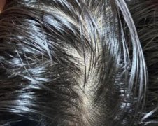 头发油腻是什么原因？产生原因、调节方式了解，看完就能解决