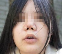 女子隆鼻变猪鼻子是真的吗？真相揭晓，注意事项、项目原理一定要先了解