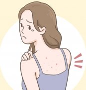 后背长痘痘是什么原因？背后元凶其实是这几个，速看