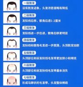 脱发1-7级程度图片怎么样？揭晓等级对照表！看看你脱发到几级了
