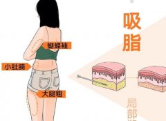 抽脂肪20斤一般多少钱？影响价格的关键因素这里有