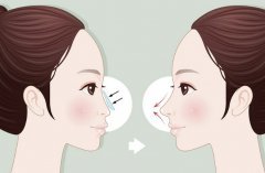 深圳福华整形医院隆鼻价格是多少？鼻整形收费明细来了，预算参考先收